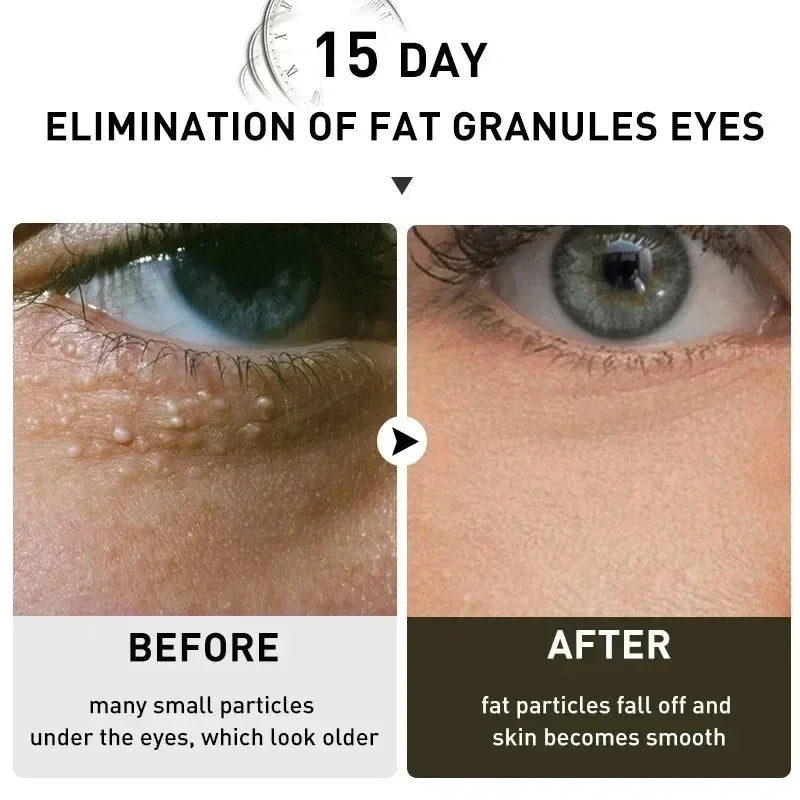 Fat Granules Removal Eyestick Anti-Puffiness Firming Cream Anti Inflammatory Fade Fine Line Repair Skin Barrier Skin Care New